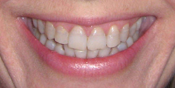 Case 2 — Full Smile Makeover — before